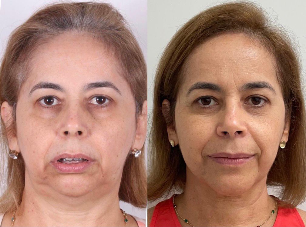 antes e depois mulher
